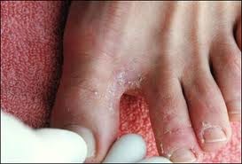 Nấm kẽ chân: do các loài Epidermophyton, Trichophyton gây nên. Tổn thương ban đầu bợt trắng hơi bong vảy, nổi một số mụn nước, ngứa nhiều, gãi trợt da, có nền đỏ, có khi viêm nề, sưng tấy do nhiễm khuẩn thứ phát, khi đó bệnh nhân có thể sốt, hạch bẹn sưng. Nấm có thể lan lên mu bàn chân, xuống mặt dưới bàn chân, đôi khi có mụn nước sâu dạng tổ dỉa ở lòng bàn chân . Ảnh: himmag