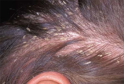 Bệnh nấm da đầu: Bệnh có tên gọi khác là bệnh Ecpet mảng tròn là bệnh nhiễm nấm dưới chân tóc , và dưới da. Nếu quan sát kỹ sẽ thấy nó biểu hiện bằng từng mảng tròn trắng , gây ngứa và khó chịu. Bệnh này có khả năng lây qua đồ dùng nếu dùng chung như mũ, nón, lược. Ảnh: tockhoedep