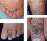 Bệnh á sừng: là một bệnh viêm da cơ địa dị ứng, là một bệnh ngoài da khá phổ biến, có thể gặp ở nhiều vị trí da khác nhau, nhưng rõ rệt nhất là ở các đầu ngón tay, chân, gót chân. Lớp da ở những vị trí này thường khô ráp, róc da, nứt nẻ gây đau đớn. Ảnh: suckhoe365
