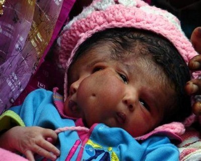 Trẻ em có khiếm khuyết này thường chết non, nhưng một bé gái tên Lali Singh, sinh năm 2008 vẫn sống sót được 2 tháng trước khi chết vì một cơn đau tim.