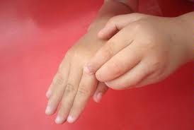 Hội chứng tay người ngoài hành tinh: những người bị hội chứng tay người ngoài hành tinh thường cảm thấy bàn tay mình di chuyển, với, cầm hoặc nắm cái gì đó ngoài tầm kiểm soát của bản thân.