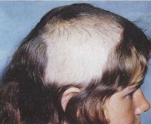 Hội chứng Trichotillomania, tên gọi hội chứng này dùng để miêu tả những người luôn luôn cảm thấy khó chịu với tấm da đầu và toàn bộ những nơi có lông trên cơ thể mình. Họ nhổ hết tóc, cạo hết lông mày, lông mi rồi lông chân, lông tay. Thậm chí đến cả “chỗ ấy” cũng không phải là ngoại lệ. Ngoại trừ vấn đề thích “trụi lông” ra, còn lại hầu hết những người mắc bệnh này có cuộc sống bình thường.