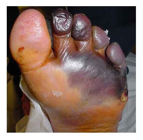 Phù chân do nhiễm trùng: Bàn và mắt cá chân bị phù có thể là dấu hiệu của nhiễm trùng, đặc biệt với người bị tiểu đường hoặc gặp các vấn đề về thần kinh. Xem thêm: Những món cháo ngon/ Những món ăn bài thuốc