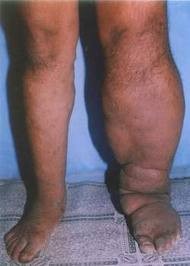 Phù chân voi: Phù chân voi (chân phù to như chân voi) là bệnh gây bởi giun chỉ. Sự hiện diện của giun chỉ ở hệ lympho (hệ bạch huyết) gây ra trình trạng viêm tắc nghẽn hệ bạch huyết Xem thêm: Những món cháo ngon/ Những món ăn bài thuốc