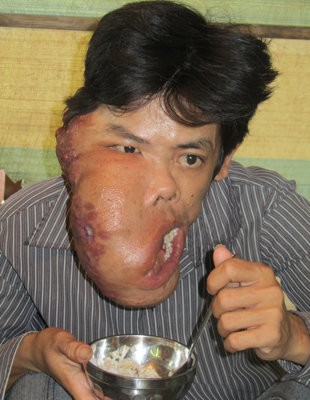 Anh Lê Hoàng Em gặp khó khăn trong ăn uống do cái bướu mặt dị dạng - Ảnh: Việt Toàn
