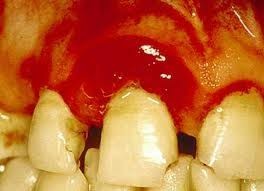 Triệu chứng: Chân răng sưng, đỏ, đau. Khi nói hay thở, miệng có mùi hôi, chân răng sưng, răng dễ lung lay, động vào răng không đau nhưng đau vùng lợi xung quanh.