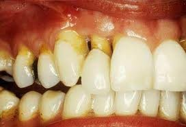 5. Cao răng: Cao răng là mảng bám đã được vôi hoá bởi các hợp chất canxi trong nước bọt, thường tập trung ở cổ răng. Bề mặt gồ ghề của cao răng chính là nơi lý tưởng để vi khuẩn phát triển. Nếu để lâu, cao răng phát triển dần về kích thước, lan dần xuống phía dưới chân răng, đẩy lợi tụt xuống, dần dần gây bệnh quanh chân răng, rụng răng. Thông thường mảng bám cần tồn tại trong miệng khoảng 1 tuần để biến thành cao răng.