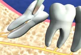 6. Răng khôn mọc lệch: Chúng ta có 4 răng khôn (2 răng ở hàm trên và 2 răng ở hàm dưới). Do không đủ khoảng trống để mọc lên theo hướng bình thường, răng tự tìm cho mình một con đường khác để mọc như: mọc ngược về phía xương hàm hoặc đâm thẳng về phía răng hàm ở bên cạnh hay nhú lên khỏi lợi được một phần và ngừng lại vĩnh viễn.