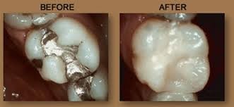 Điều trị: Dùng vật liệu hàn để bịt kín lỗ sâu răng, ngăn không cho vi khuẩn hoặc các tác nhân bên ngoài như nhiệt độ, hoá chất tấn công, huỷ hoại tuỷ răng. Có 3 loại vật liệu được sử dụng nhiều nhất trong hàn răng là Composite, Glassionomer (Fuji), Amalgam.
