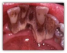 2. Bệnh viêm lợi: Nguyên nhân do vi khuẩn ở trong mảng bám răng hoặc cao răng tồn tại lâu trong miệng. Vi khuẩn ở mảng bám tồn tại càng lâu thì mức độ nghiêm trọng mà chúng có thể gây ra càng lớn.