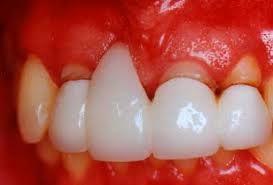 Triệu chứng: Lợi của người bệnh bị sưng đỏ, dễ chảy máu, đặc biệt là khi đánh răng.