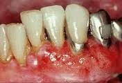 3. Bệnh viêm quanh răng: Khi bệnh viêm lợi không được quan tâm và điều trị thì sẽ phát triển thành bệnh viêm quanh răng. Lợi sẽ dần dần tụt khỏi răng, tạo nên những túi lợi sâu, tạo điều kiện cho vi khuẩn phát triển và làm trầm trọng thêm mức độ của bệnh. Không những thế, bệnh còn làm cho xương và dây chằng bao bọc quanh răng cũng bị tiêu huỷ dần, khiến cho răng không có chỗ dựa, trở nên lung lay và cuối cùng sẽ rụng.