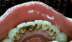 Dấu hiệu của bệnh viêm quanh răng: hôi miệng, sưng, đỏ lợi, chảy máu lợi, cảm giác đau khi nhai, răng lung lay...