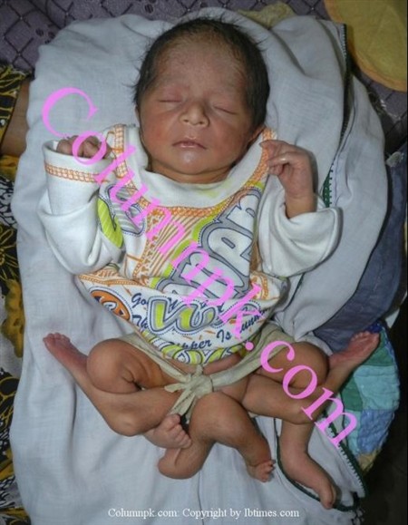 Bé sáu chân được sinh ra tại bệnh viện huyện Sukkrur, tỉnh Sindh, Pakistan.