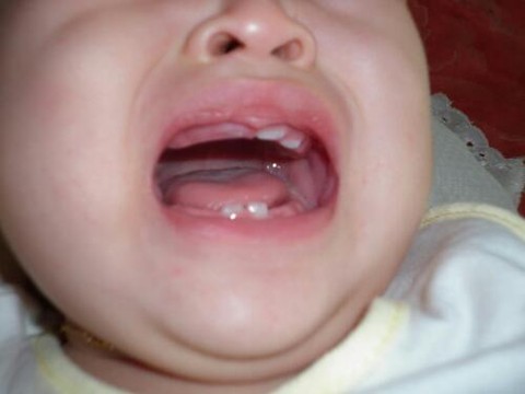 Khi mọc răng, bé sẽ có đôi chút xáo trộn trong ăn uống và sinh hoạt hàng ngày, song bạn đừng lo lắng. Điều tốt nhất bạn có thể mang lại cho bé là thật nhiều ôm ấp, ve vuốt yêu thương. Hãy nhẹ nhàng xoa bóp lợi cho bé, để bé được nhay nhay ngón tay bạn (nhớ là phải giữ gìn vệ sinh). Xem thêm: Chùm ảnh: Sự nguy hiểm của việc sâu răng ở trẻ / Ung thư trẻ em: Tử vong nhiều nhưng chưa được quan tâm / 10 căn bệnh ung thư thường gặp ở trẻ và các dấu hiệu nhận biết khi mắc phải