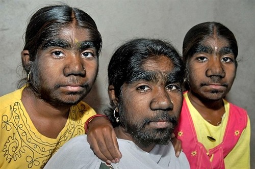 Ba chị em Savita, Monissh và Savitri Sangli bị mắc hội chứng “người sói” (từ trái qua). Ảnh: DM. Xem thêm: Phát hoảng với những thân hình "khủng" nhất thế giới do ăn nhiều / Những hình ảnh thương tâm về căn bệnh 'lạ' ở Quảng Ngãi