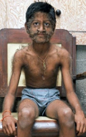 Pruthviraj Patil (13 tuổi, Ấn Độ) phải chịu một chứng bệnh mà y học gọi là "hội chứng người sói" - một trong những bệnh hiếm gặp nhất thế giới, xác suất 1/1.000.000 người. Xem thêm: Phát hoảng với những thân hình "khủng" nhất thế giới do ăn nhiều / Những hình ảnh thương tâm về căn bệnh 'lạ' ở Quảng Ngãi