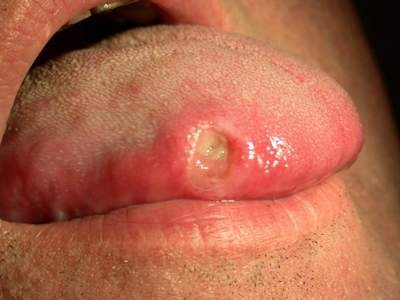 Tổn thương do bệnh nhiệt miệng (X).