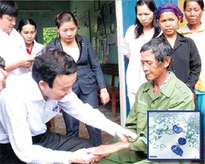 Các chuyên gia y tế thăm khám cho bệnh nhân mắc bệnh viêm da bàn tay, bàn chân tại xã Ba Điền, huyện Ba Tơ, tỉnh Quảng Ngãi. Ảnh: Thanh Long