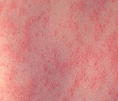 Bệnh sởi (tiếng Anh: measles hay rubeola) là một bệnh nhiễm virus cấp tính đặc trưng ở giai đoạn cuối bằng ban dạng dát-sẩn xuất hiện tuần tự từ cổ, mặt, ngực, thân, chân tay kèm theo sốt cao. (Ảnh: Yte) Xem thêm: Ghê sợ: Bệnh dại - Nguyên nhân và cách phòng tránh/ Chùm ảnh: Loài kiến và những tác hại đối với con người