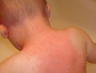 Sau đó, bệnh nhân có thể bị sốt cao lên tới 40 đến 40,5 độ C. Cùng lúc đó, những mảng đỏ nổi lên, thường là ở trên mặt, theo đường tóc và sau tai. Những vết đỏ hơi ngứa này có thể dấn lan xuống ngực, lưng và cuối cùng xuống tới đùi và bàn chân. (Ảnh: thaythuocvietnam) Xem thêm: Ghê sợ: Bệnh dại - Nguyên nhân và cách phòng tránh/ Chùm ảnh: Loài kiến và những tác hại đối với con người