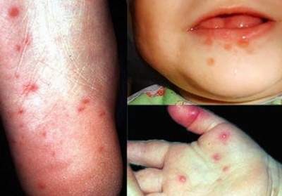 Tổn thương tay - chân - miệng do virut Coxsackie gây ra.