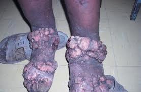 Đa số trường hợp, "chân voi" do một loại ký sinh trùng có tên là giun chỉ gây ra, đó là bệnh giun chỉ bạch huyết. Ký sinh trùng này truyền từ người sang người qua vết muỗi đốt.