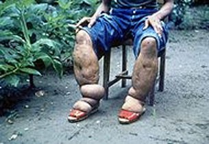 Hiện các nhà khoa học vẫn đang tiếp tục nghiên cứu để xác định các phân tử chính bị ảnh hưởng bởi biến thể di truyền trong việc tăng nguy cơ nhiễm bệnh chân voi. Đồng thời tiếp tục khuyến cáo người dân nên đi dép, giày để bảo vệ chân.