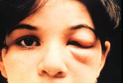 Một triệu chứng của bệnh nhân Chagas trong giai đoạn cấp tính