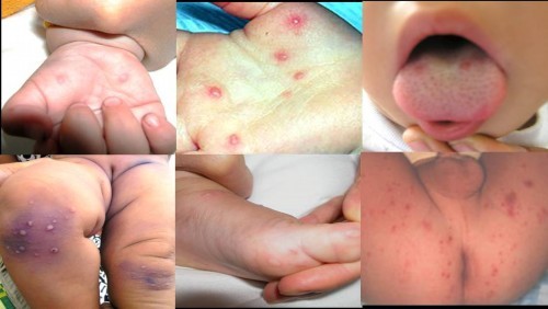 Bệnh tay chân miệng: Bệnh TCM lây qua dịch tiết mũi họng của trẻ bắn trực tiếp qua trẻ khác nếu tiếp xúc gần hoặc dính lên tay chân của trẻ khác, sau đó dùng tay đưa thức ăn vào miệng. Xem thêm: Bí quyết "nhỏ", giữ sức khỏe "lớn" trong mùa nắng nóng