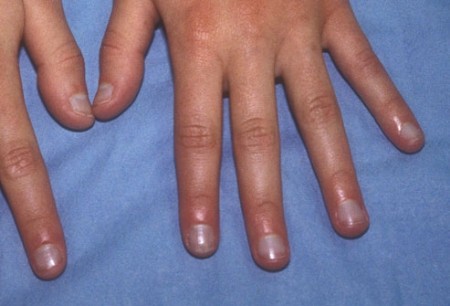 4. Móng tay hơi xanh: Móng tay hơi xanh có thể là do cơ thể bạn không nhận đủ oxy. Đó là biểu hiện của bệnh về phổi (như viêm phổi) và bệnh về tim. Xem thêm: Cảm cúm, cảm lạnh dùng thực phẩm gì có lợi nhất?