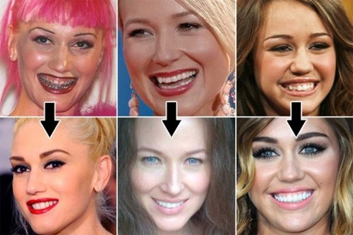 Rất nhiều ngôi sao nổi tiếng trên thế giới cũng "trùng tu" hàm răng để có nụ cười duyên. Xem thêm:Album quý: nhan sắc mặn nồng của "bông hồng nước Anh"