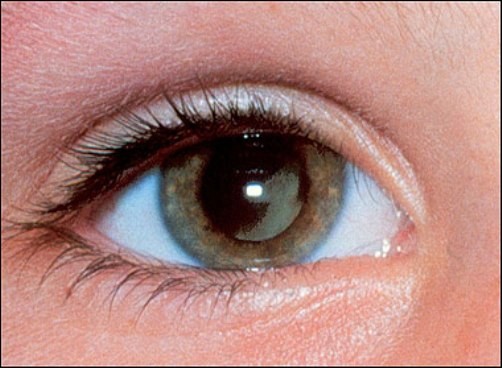 Vết sưng hay một đốm màu nâu trên mí mắt: Hầu hết u bướu ác tính ở vùng mí mắt là kết quả của bệnh ung thư tế bào đáy. Khi khối u như một đốm màu nâu xuất hiện thì đó là triệu chứng của u hắc sắc tố ác tính - một loại ung thư da khác. Xem thêm: Móng tay... nói lên bệnh tật: tim, gan, phổi