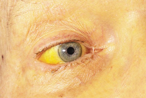 Vết sưng màu vàng nổi lên trên mí mắt: Khi trên mí mắt xuất hiện vết sưng màu vàng nhỏ, đó được gọi là ban vàng mí mắt. Hiện tượng này xuất hiện do các mô mỡ đọng lại, đồng thời cũng là dấu hiệu cảnh báo rằng bạn đang có lượng cholesterol cao. Xem thêm: Móng tay... nói lên bệnh tật: tim, gan, phổi