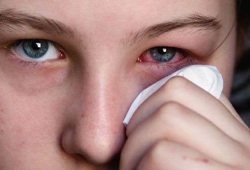 Mắt đỏ và ngứa: Có rất nhiều nguyên nhân khiến đôi mắt bị kích ứng, nhưng nếu mắt ngứa, kèm theo hiện tượng hắt hơi, ho, nghẹt hoặc sổ mũi thì đó thường là do dị ứng. Xem thêm: Móng tay... nói lên bệnh tật: tim, gan, phổi