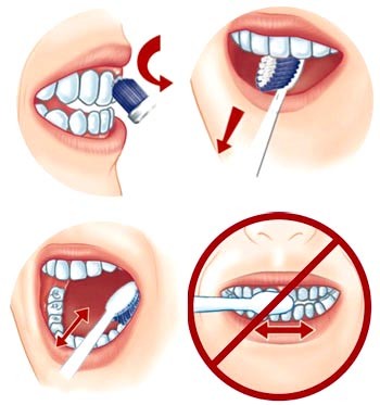 Chải răng đúng cách ngăn ngừa được mòn răng.
