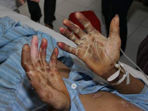 Một bệnh nhân hoại tử chân tay do nhiễm liên cầu lợn