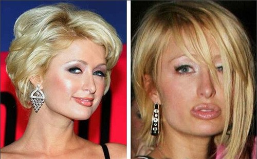 Paris Hilton với đôi môi sưng phồng sau khi tiêm botox.
