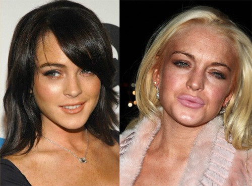 Lindsay Lohan ngày càng lún sâu vào con đường nghiện bơm môi.