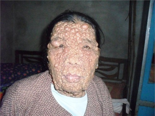 Người đàn bà mọc “sung” khắp người: Căn bệnh này xuất hiện trên người phụ nữ 53 tuổi bà Nguyễn Thị Đáng ở Bình Lục, Hà Nam. Theo Y học hiện đại thì bệnh này được gọi là u thần kinh da. Đây cũng là căn bệnh rất hiếm gặp trên thế giới.