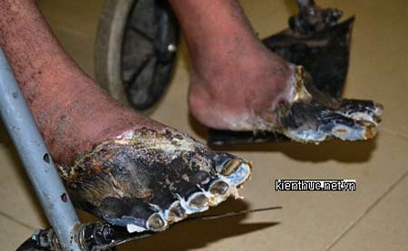 Sau khi được Bệnh viện Chợ Rẫy TP.HCM phẫu thuật cắt bỏ hai bàn chân chết khô, ngày 22/7, bệnh nhân Cil Ha Toàn đã được xuất viện trở về quê nhà.
