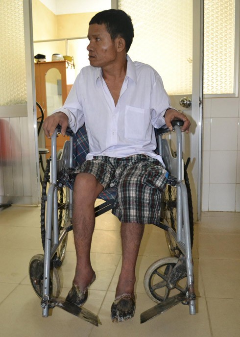 Hai bàn chân người sống bỗng nhiên "chết khô" Căn bệnh lạ này khiến anh Cil Ha Toàn (xã Đạ Đờn, huyện Lâm Hà, tỉnh Lâm Đồng) đau đơn, nhức buốt nhiều năm liền. Các ngón chân và hai bàn chân từ thâm tím sau đó chuyển qua lở loét, chảy nước và bốc mùi hôi. Ngay sau khi tiếp nhận ca bệnh này vào ngày 10/7/2012, khoa Ngoại chấn thương Bệnh viện đa khoa Lâm Đồng đã chuyển bệnh nhân về Bệnh viện Chợ Rẫy ở TP HCM để được chữa trị tốt hơn.