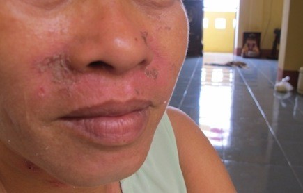 Khuôn mặt chị Nguyễn Thị Hoa tại phòng G1-302 bị côn trùng lạ tấn công khiến khuôn mặt của chị bị rộp và mưng mủ, dù chị đã bôi thuốc nhưng vẫn chưa khỏi.