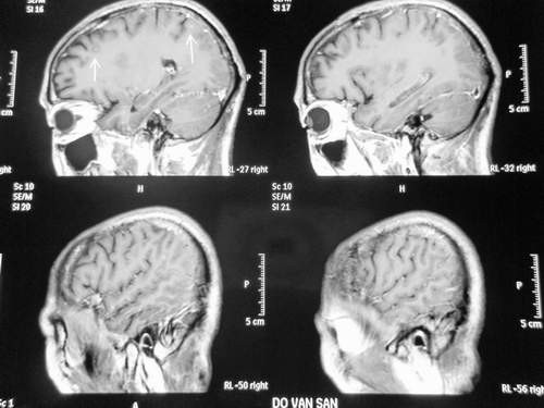 Hình ảnh nấm não trên MRI (T2).