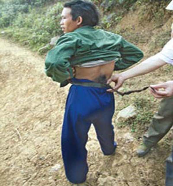 Ở Việt Nam, người đàn ông có tên Vàng Seo Chúng, sống ở xã Pà Vầy Sủ, huyện Xín Mần, Hà Giang, cũng có 1 túm lông mọc như một cái đuôi dài. Ông đã từng cố gắng cắt bỏ cái đuôi nhưng mỗi lần cắt là 1 lần ốm “thập tử nhất sinh”.
