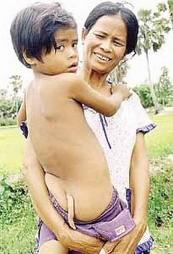 Cậu bé Chhorn Tola, sống ở làng Chheu Kach, Campuchia khi sinh ra cũng đã có 1 bộ phận thừa trông như 1 cái đuôi.