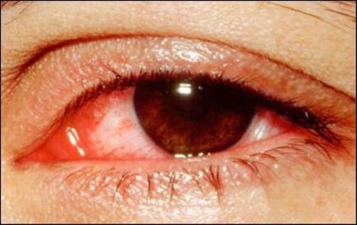 1. Đau mắt đỏ hay viêm màng tiếp hợp cấp thường xảy ra rất đột ngột. Có người chỉ đau một mắt, có người bị cả hai mắt, tiến triển rất nhanh, hay lây và phát triển thành dịch. Bệnh thường lây qua sự tiếp xúc như từ bàn tay dụi lên mắt, dùng chung chậu, bồn rửa mặt, khăn mặt để chồng lên nhau...