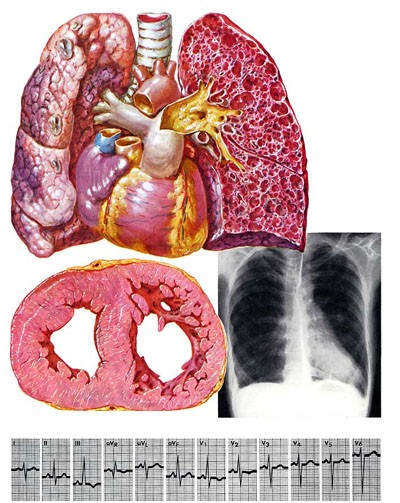 6. Chức năng phổi: Tốc độ hô hấp giảm dần theo tuổi tác, dẫn đến chất độc hại đọng lại trong phổi nhiều hơn sau mỗi hơi thở. Vì thế, tỷ lệ nhiễm trùng gia tăng và bệnh phổi sẽ xuất hiện.