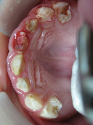 Nếu bạn bị sâu răng, bạn sẽ biết ngay? Đó là một hiểu lầm tai hại. Ở giai đoạn đầu của sâu răng thì sẽ không có biểu hiện triệu chứng gì. Đến khi bạn cảm nhận được nỗi đau của những chỗ sâu răng gây ra thì lúc đó sâu răng đã ở mức độ nặng và gây tổn hại dây thần kinh rất nhiều rồi. Vậy nên hãy thường xuyên tự kiểm tra răng để phát hiện sớm các bệnh ở răng miệng.