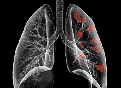 1. Ung thư phổi và phế quản: Ung thư phổi và phế quản là căn bệnh ung thư gây tử vong hàng đầu ở Mỹ. Theo NCI, khói thuốc và hút thuốc lá là những nguyên nhân chính gây ra căn bệnh này. Bệnh phần lớn gặp ở những người từ 55 đến 65 tuổi.